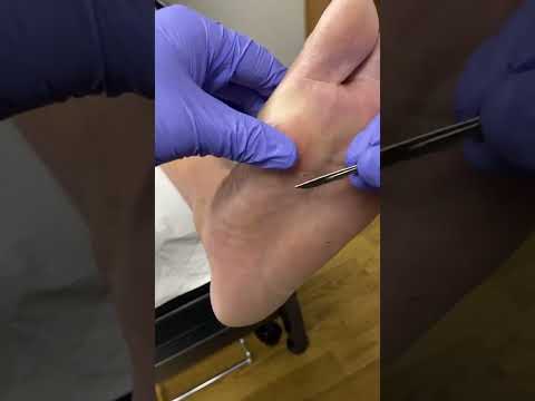 Transform your feet with an amazing callus removal! Witness the satisfying process as a skilled