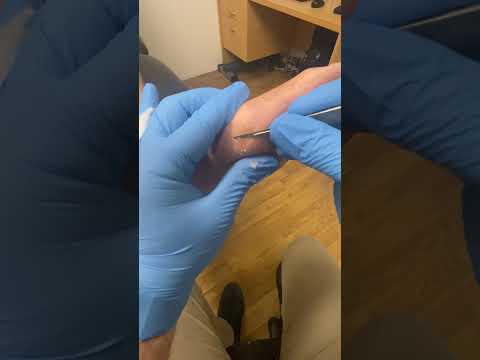 Extreme Foot Transformation Deep Pinch Callus Removed by Podiatrist #FootCare #CallusRemoval