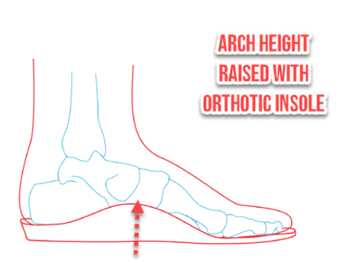 Say Goodbye to Flat Feet: How Orthotics Provide Relief