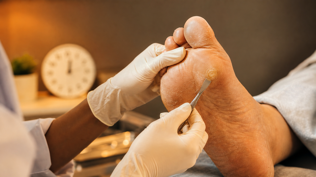 Podiatrist reducing a dry corn during a clean clinical treatment