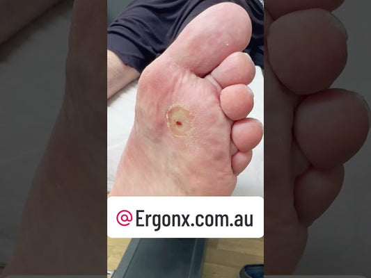 Miracle Corn & Callus Removal by Australian Podiatrist #FootCare #PodiatryMiracle