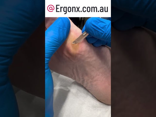 Ultimate Foot Transformation Satisfying Callus Removal by Australian Podiatrist #FootCare #Podiatry
