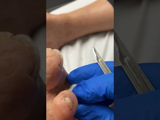 Tip of Toe Callus Removal #corn #callus #docpods #ergonx #toecallus #footcallus #satisfying
